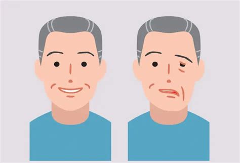 Understanding Bells Palsy