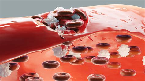 Understanding Blood Clots