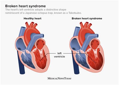 Understanding Broken Heart Syndrome
