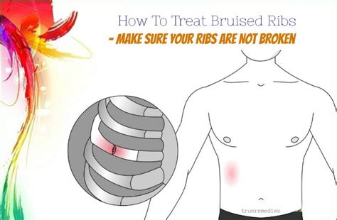 Understanding Bruised Ribs