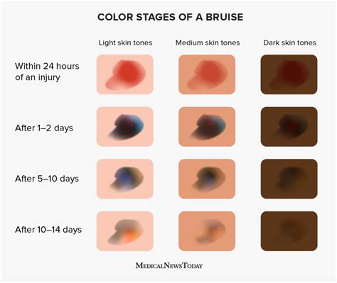 Understanding Bruising