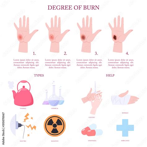 Understanding Burn Treatment