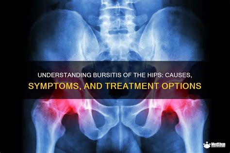 Understanding Bursitis Treatment Options