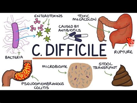 Understanding C. diff