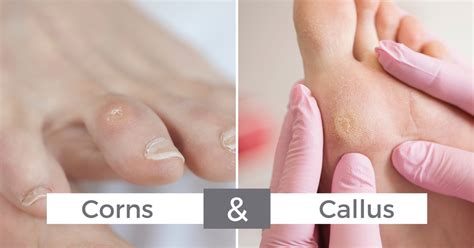 Understanding Calluses
