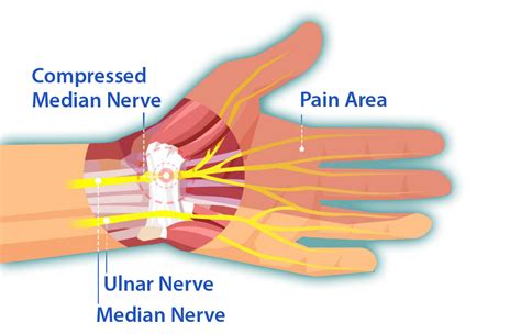 Understanding Carpal Tunnel Syndrome