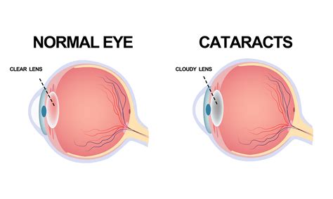 Understanding Cataracts