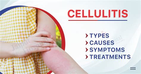 Understanding Cellulitis