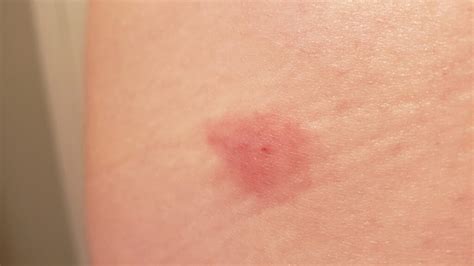 Understanding Circular Bug Bites