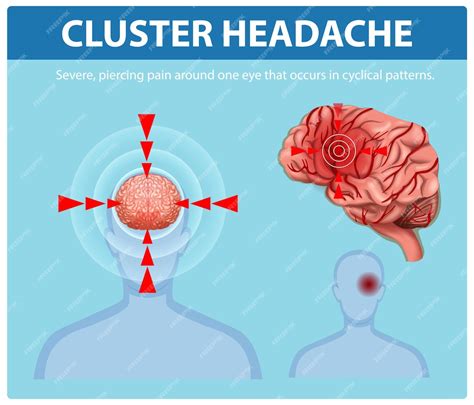 Understanding Cluster Headaches