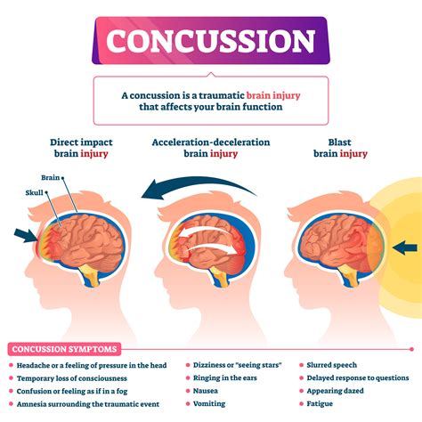 Understanding Concussions