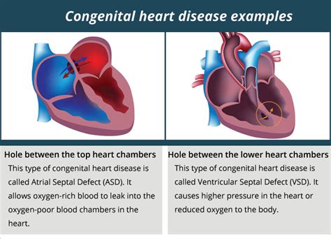 Understanding Congenital Heart Disease