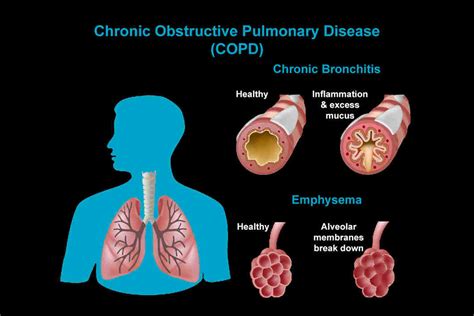 Understanding Copd