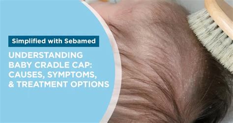 Understanding Cradle Cap