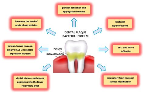 Understanding Dental Plaque