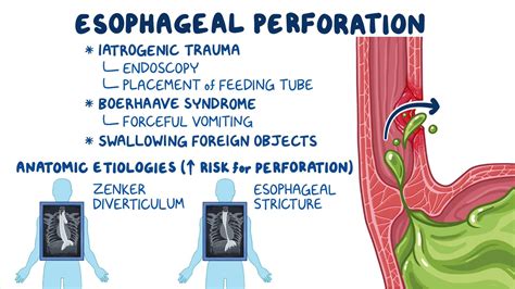 Understanding Esophageal Spasms