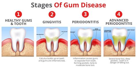 Understanding Gum Disease
