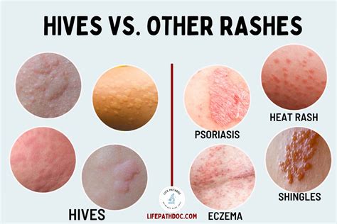 Understanding Hives