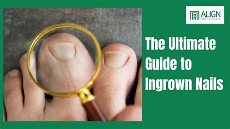 Understanding Ingrown Toenails