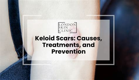 Understanding Keloids