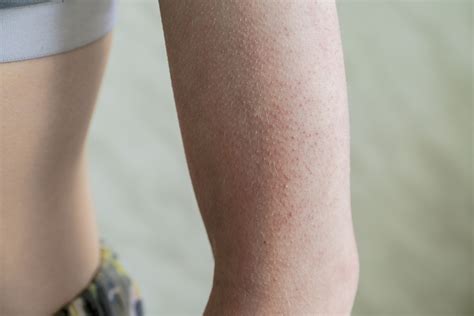 Understanding Keratosis