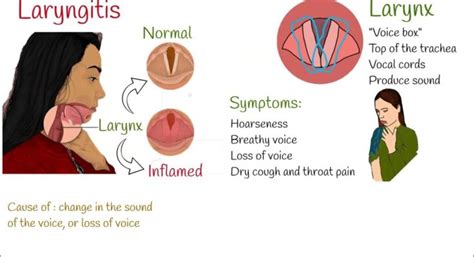 Understanding Laryngitis