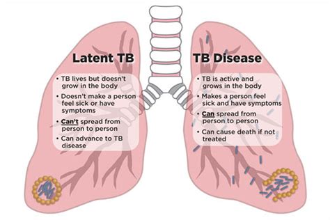 Understanding Latent TB