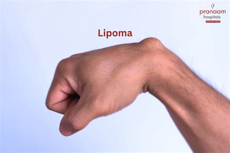 Understanding Lipomas