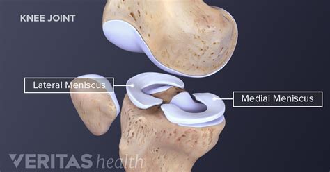 Understanding Meniscus Tears