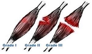 Understanding Muscle Strains