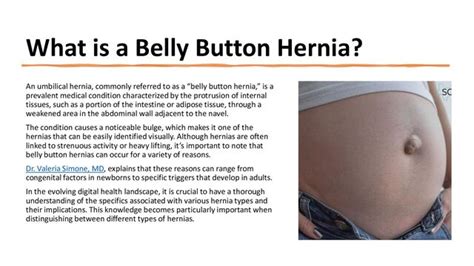 Understanding Navel Hernias