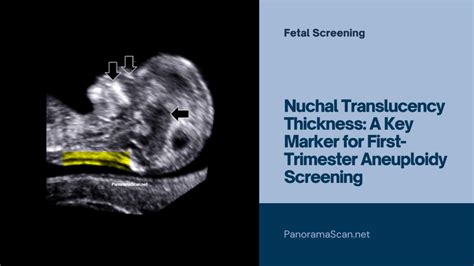 Understanding Nuchal Translucency Results