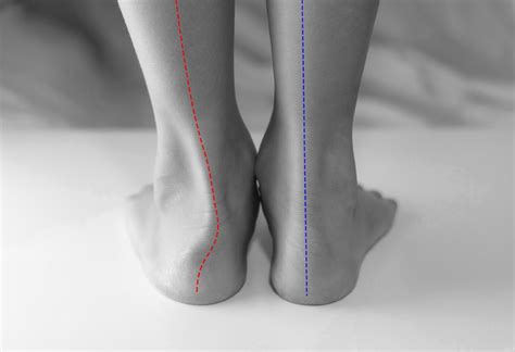 Understanding Pronation