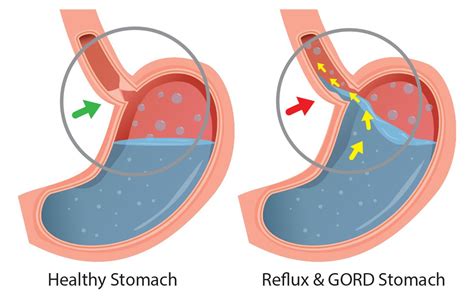Understanding Reflux Surgery