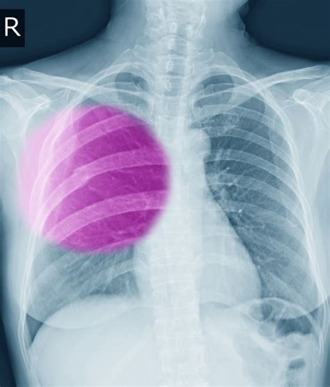 Understanding Rib Fracture Care