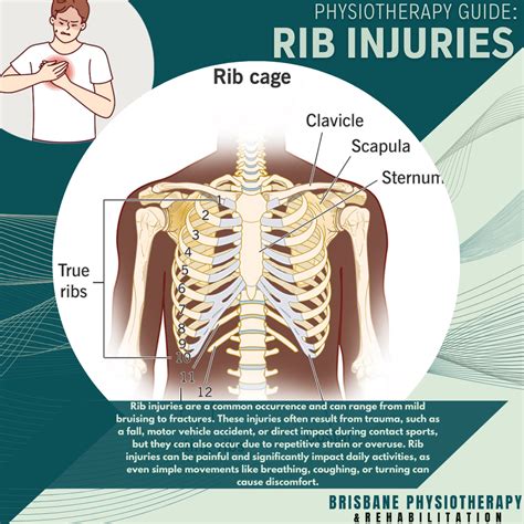 Understanding Rib Injuries