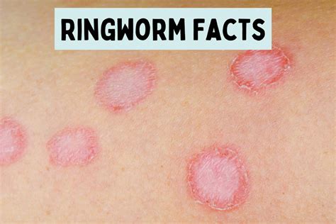 Understanding Ringworm