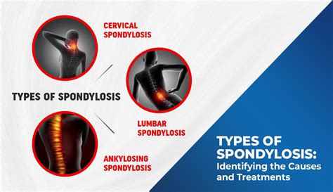 Understanding Spondylosis