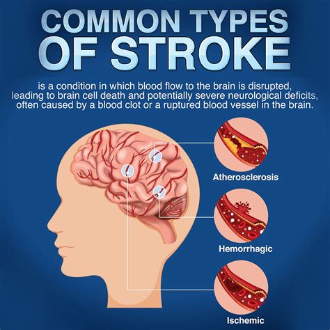 Understanding Strokes