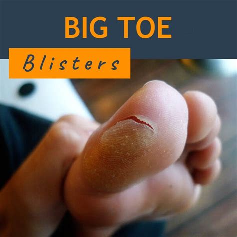 Understanding Toe Blisters