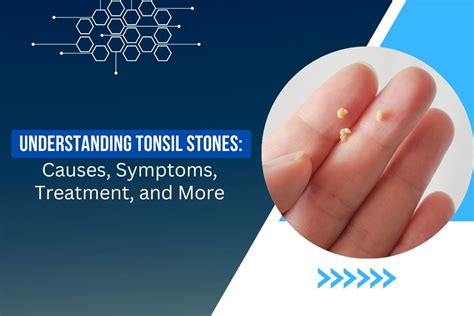 Understanding Tonsil Stones