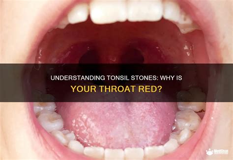 Understanding Tonsilloliths