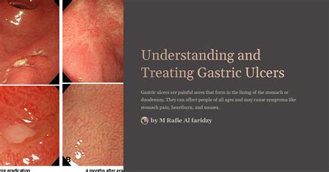 Understanding Ulcers