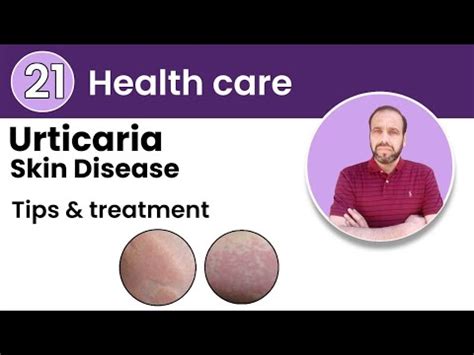 Understanding Urticaria