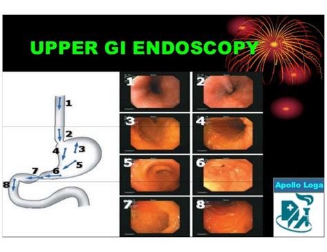 Upper GI Endoscopy Procedure for Specific Conditions