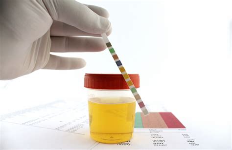 Urine Culture Test