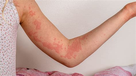 Urticaria Treatment