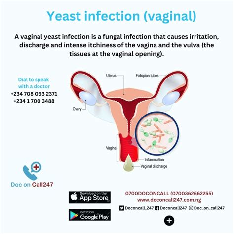 Vaginal Yeast Infections