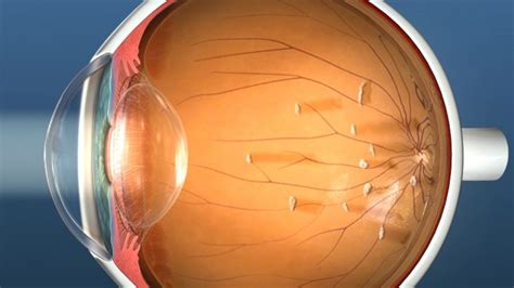 Vitrectomy for Eye Floaters