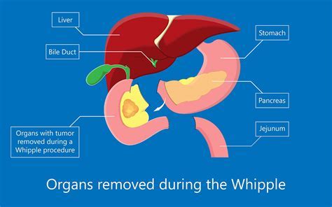 Whipple Procedure Overview